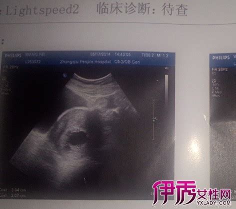 怀孕三个月双胞胎b超图