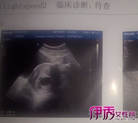 三个月胎儿真实图