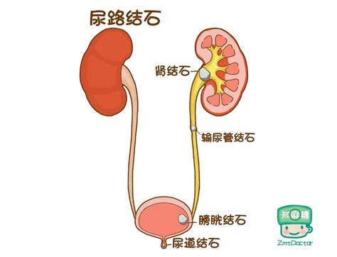 双侧肾盂无分离什么意思