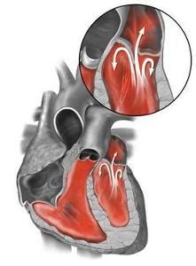 二三尖瓣返流能活多久