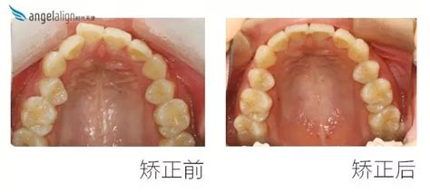 整牙拔牙好还是推磨牙向后好