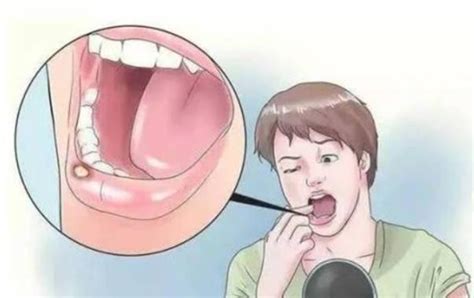 口腔溃疡会引起淋巴结肿大吗是癌吗