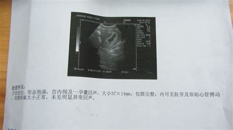 怀孕七个月肚脐眼突出是男孩还是女孩