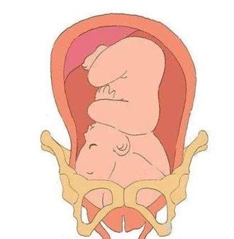 孕18周胎停肚子会软吗