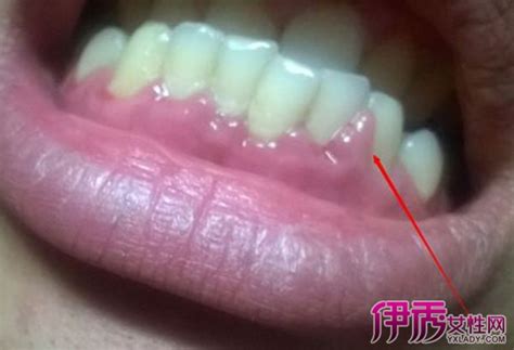 牙龈炎怎么冶疗