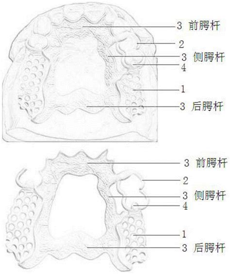 可摘局部义齿取模图