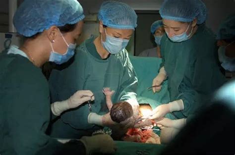 子痫剖宫产对胎儿的影响