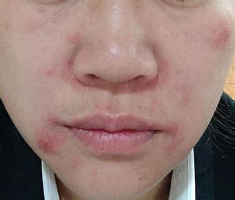怀孕六个月脸上突然过敏