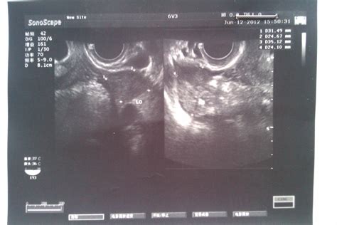 三胞胎怀孕两个月b超单子图片