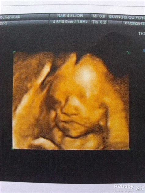 怀孕24周胎儿彩超图片