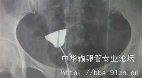 输卵管堵塞10个征兆