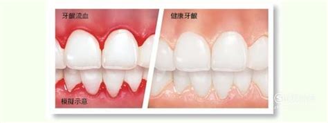 牙疼牙龈出血吃什么药