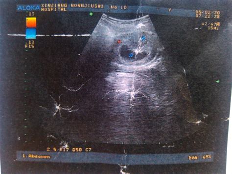 孕9周胎儿标准图片