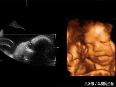 四维彩超图片和出生后的照片