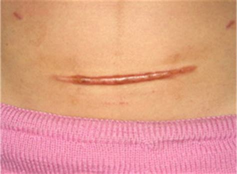 剖腹产疤痕对女性有什么影响
