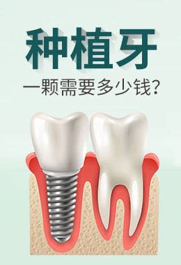 口腔医院种牙一般多少钱一颗