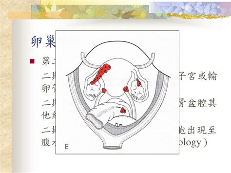 为什么说卵巢癌被称为妇癌之癌