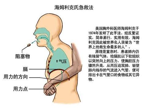 海姆立克急救方法儿童视频