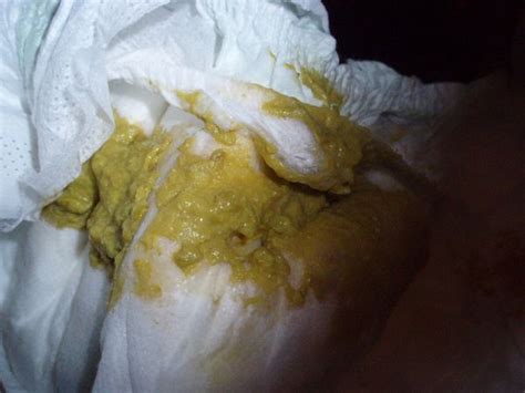 一岁5个月宝宝拉肚子怎么办