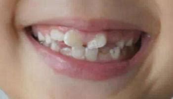 孩子的牙齿长得很丑怎么办