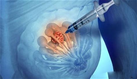 右侧乳腺内实性结节3类