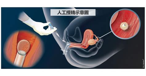 人工受孕费用大概多少