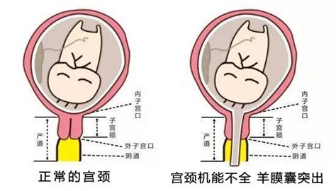 什么原因会导致先兆流产?