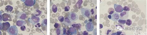 巨幼细胞性贫血的临床表现