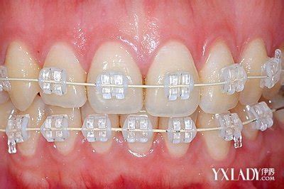 树脂假牙有什么优缺点