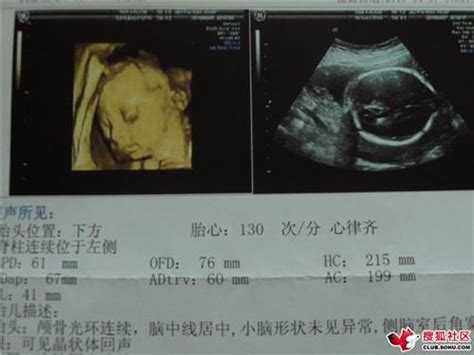 孕期胎儿心脏彩超有必要做吗