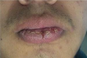 小孩嘴唇干裂起泡怎么办