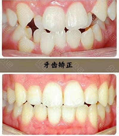 广州口腔医院牙齿矫正