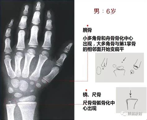 十岁孩子骨龄十三岁