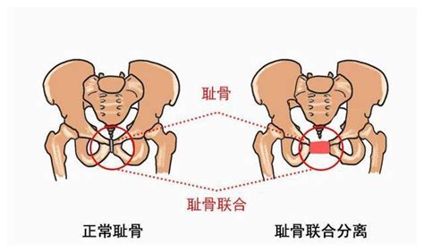 怎样缓解孕妇耻骨疼