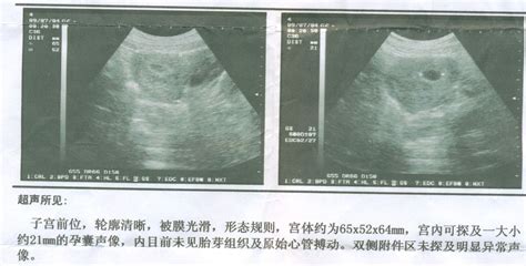 怀孕20周胖了几斤正常