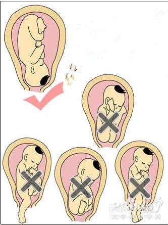 孕妇40周胎位不正