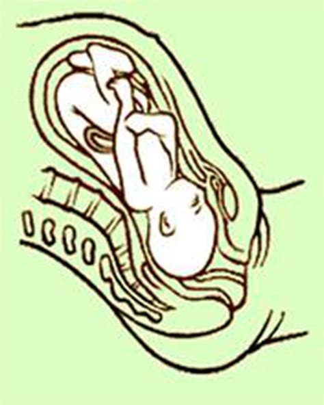 怀孕23周胎儿臀位怎么办
