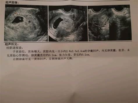 胎心150正常吗还缺氧吗