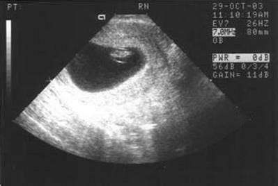 b超45天孕囊呈圆形