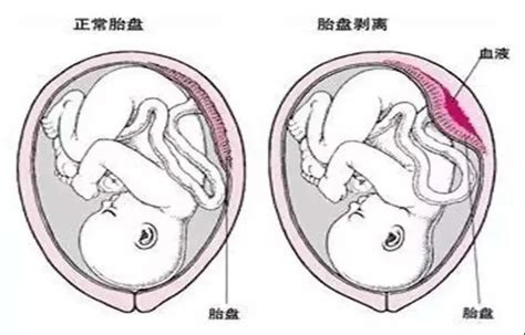 怀孕36周胎动频繁正常吗