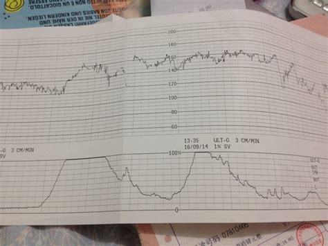 规律的宫缩胎心监护图