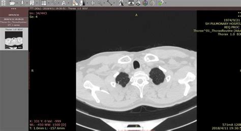 请问你,读取双膝mri dicom格式文件大概有多大?我想拷在盘里,不知用什么盘拷贝