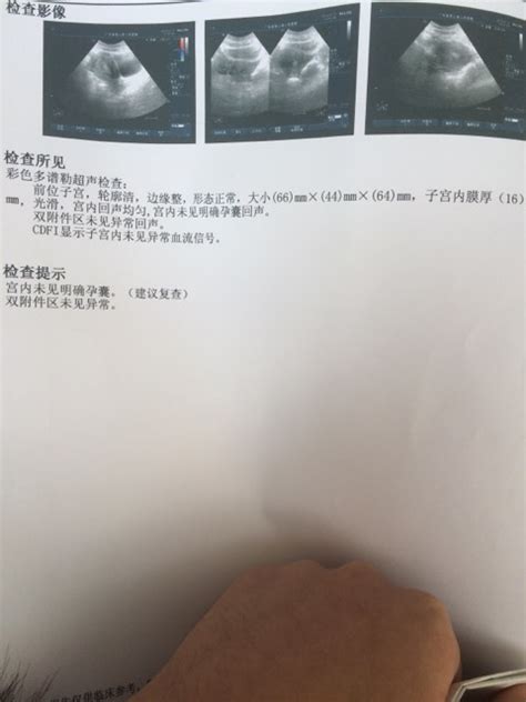 b超单未见卵黄囊