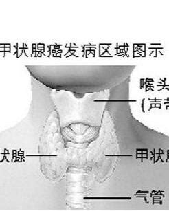 甲状腺癌只切除一侧会复发吗