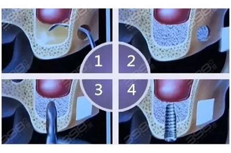 种植牙过程和步骤视频