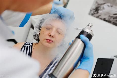 尋常疣用液氮冷凍治療一般要幾次才能治好啊