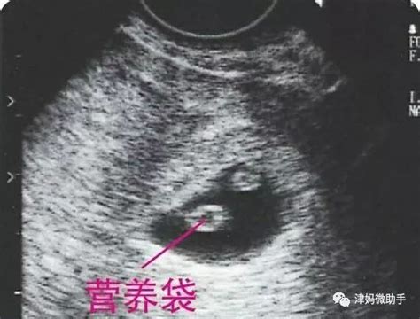 怀孕后胎儿不能要的情况有哪些
