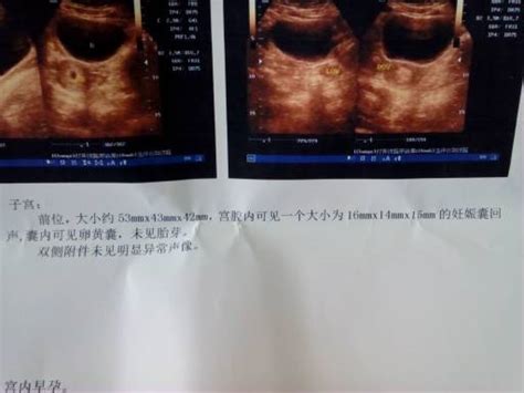 怀孕43天检查没有胎囊