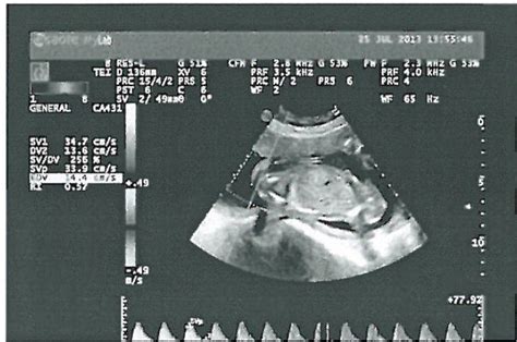 孕38周胎儿腹围正常值