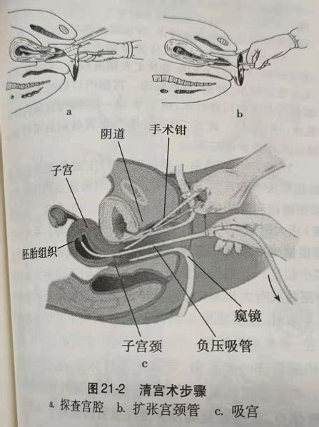 清宫和刮宫哪个伤害更大